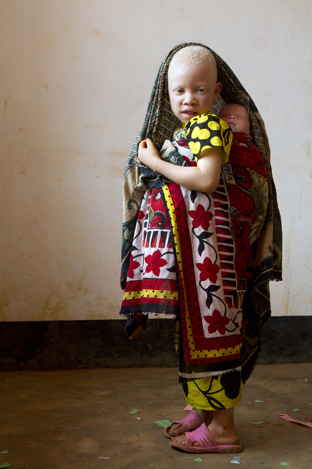 Portraits of      Albinism: Tribe of Ghost
